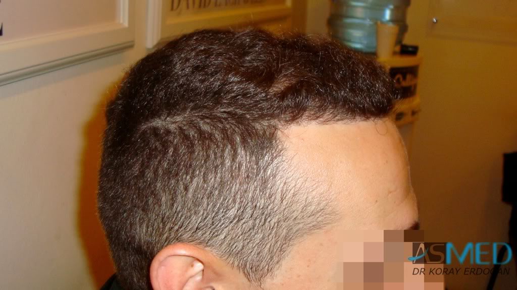 Norwood3 2300-grafts-FUE 54415fb8