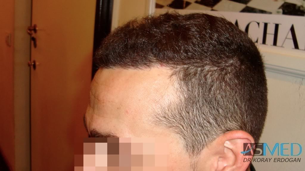 Norwood3 2300-grafts-FUE 903315a5
