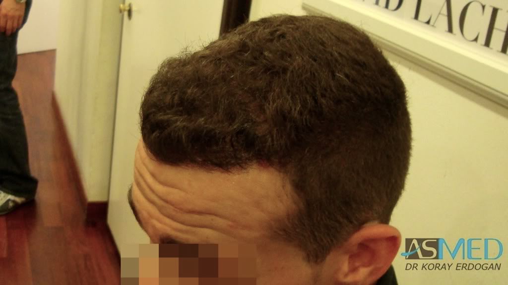 Norwood3 2300-grafts-FUE abeec086