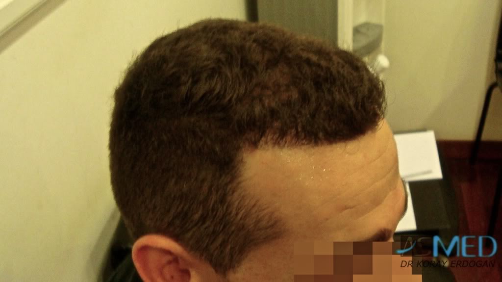 Norwood3 2300-grafts-FUE c57cfae9
