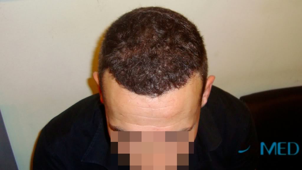 Norwood3 2300-grafts-FUE e5bf26af