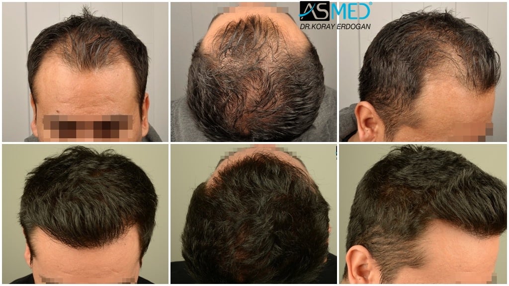 2400-grafts-FUE-2 gallery