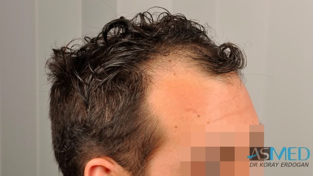Norwood3 2400-grafts-FUE-3 0cb32e7f