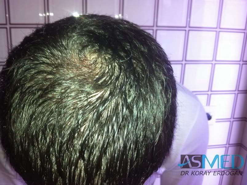 Norwood3 2400-grafts-FUE-3 141e8d9c