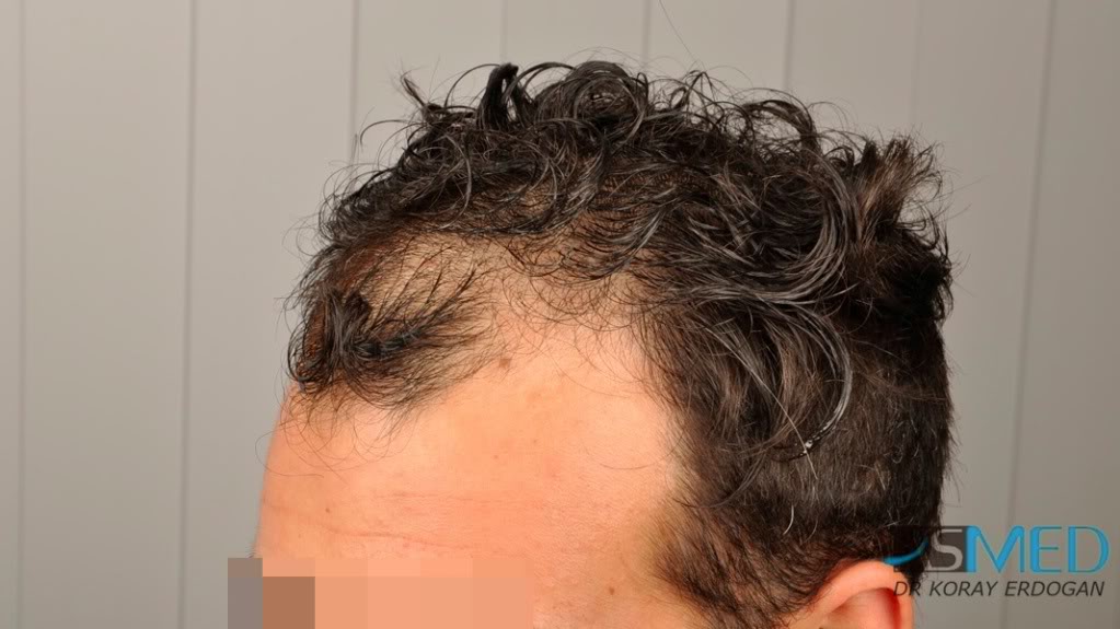 Norwood3 2400-grafts-FUE-3 1fd79312