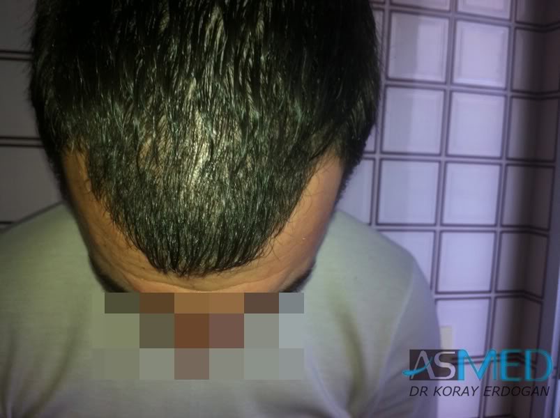 Norwood3 2400-grafts-FUE-3 30ce9724