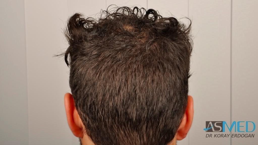 Norwood3 2400-grafts-FUE-3 40fb7b67