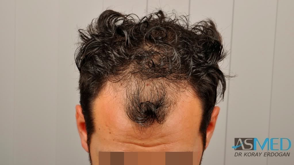 Norwood3 2400-grafts-FUE-3 488dc140