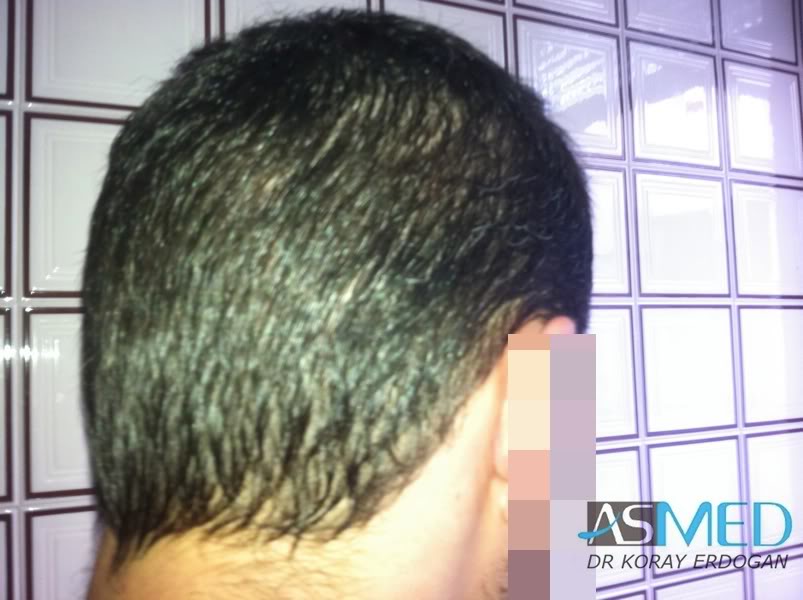 Norwood3 2400-grafts-FUE-3 5536f18c