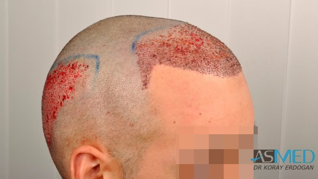 Norwood3 2400-grafts-FUE-3 6af01338