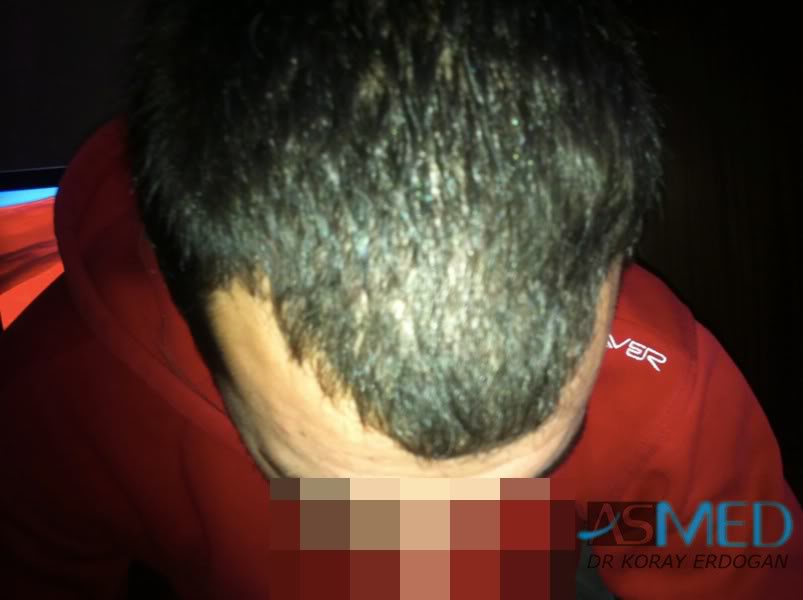 Norwood3 2400-grafts-FUE-3 7e5e65cf
