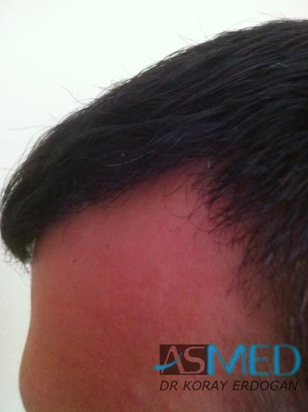Norwood3 2400-grafts-FUE-3 84464f40
