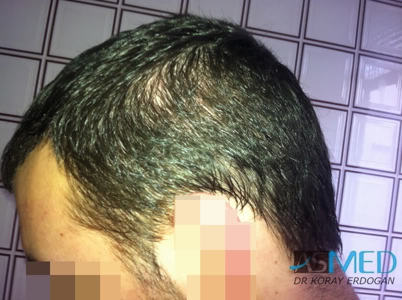 Norwood3 2400-grafts-FUE-3 87acadf1