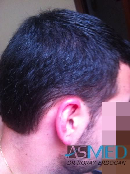 Norwood3 2400-grafts-FUE-3 8b511f54