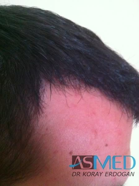 Norwood3 2400-grafts-FUE-3 9100a954