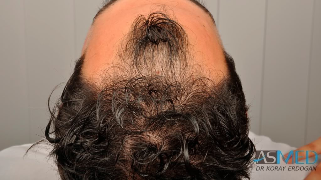 Norwood3 2400-grafts-FUE-3 b26632e0
