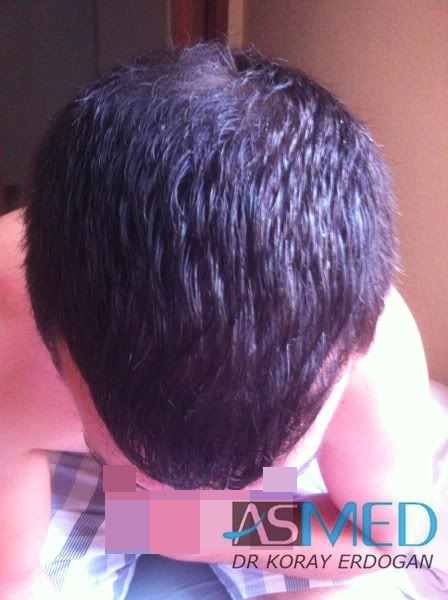 Norwood3 2400-grafts-FUE-3 d381bc28