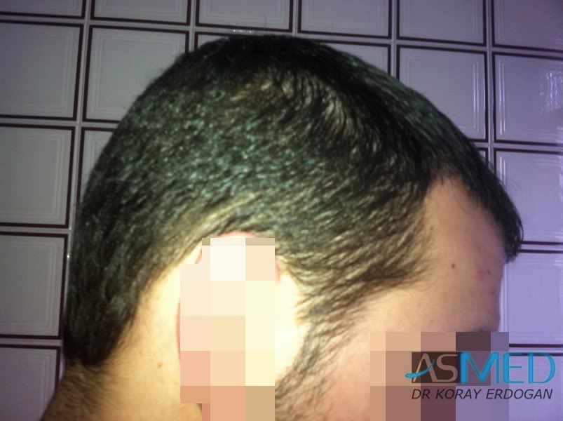 Norwood3 2400-grafts-FUE-3 d46ffd94