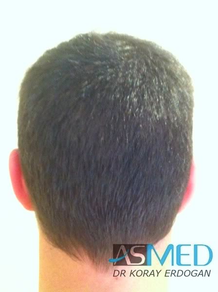 Norwood3 2400-grafts-FUE-3 da231acd