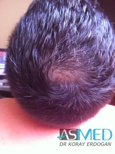 Norwood3 2400-grafts-FUE-3 f87eec9c