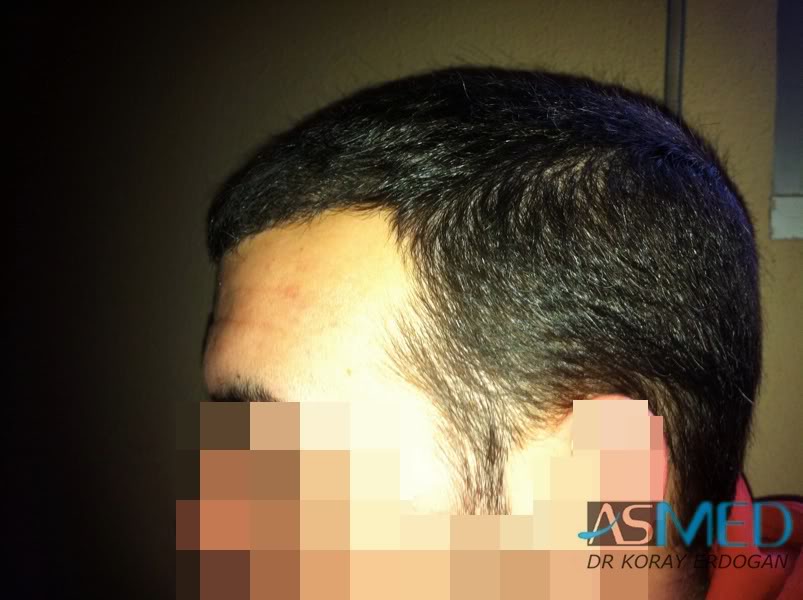 Norwood3 2400-grafts-FUE-3 fa707693