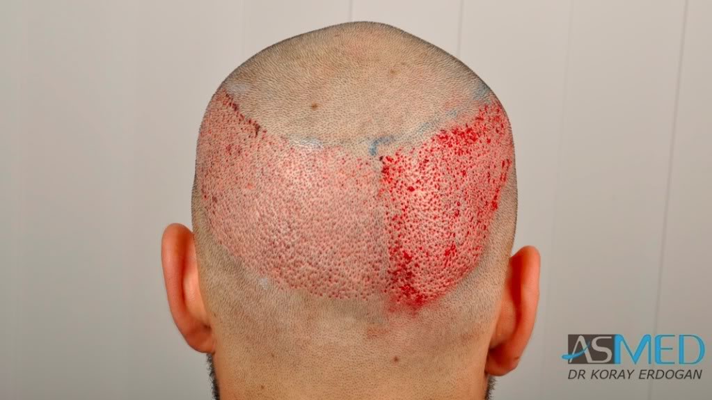 Norwood3 2400-grafts-FUE-3 fa93f086
