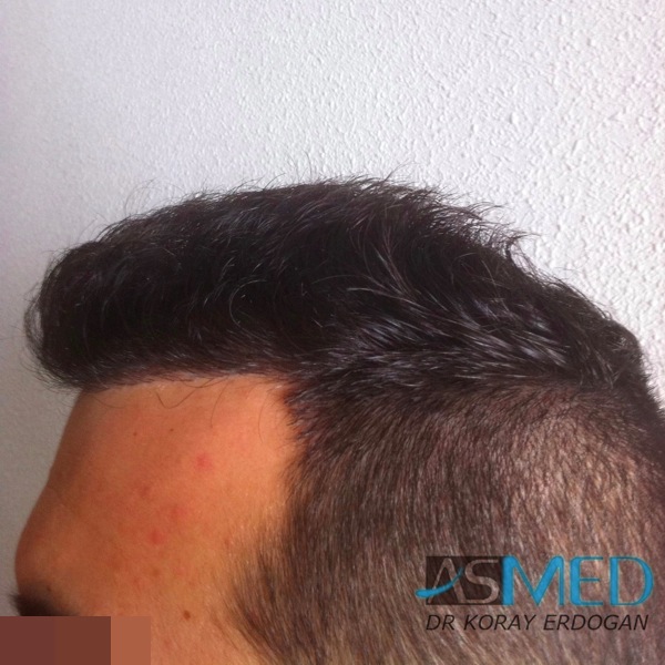 Norwood3 2400-grafts-FUE-3 file-11