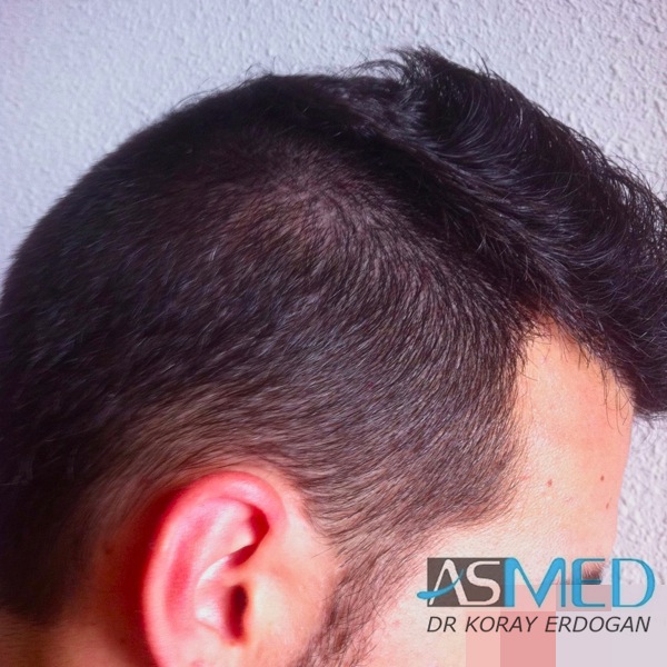 Norwood3 2400-grafts-FUE-3 file-7