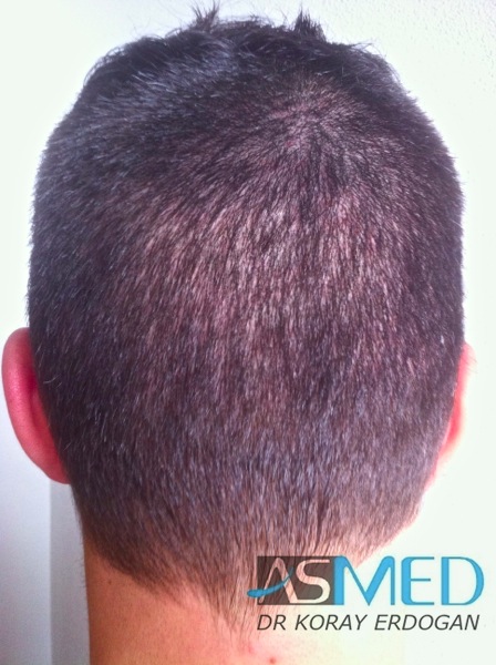 Norwood3 2400-grafts-FUE-3 file-9