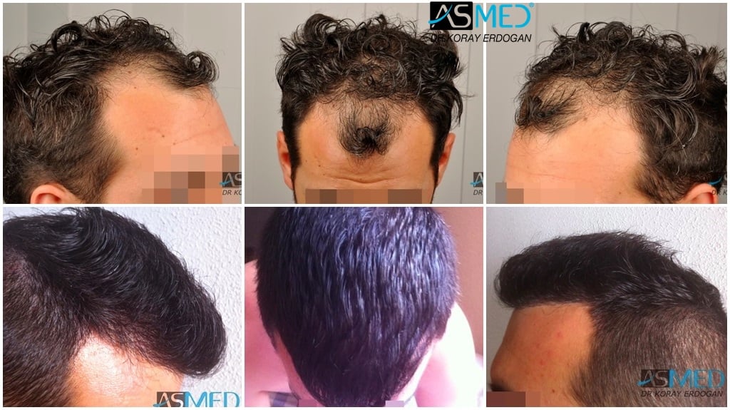 2400-grafts-FUE-3 gallery