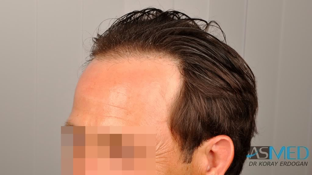 Norwood3 2400-grafts-FUE-4 0dc08110