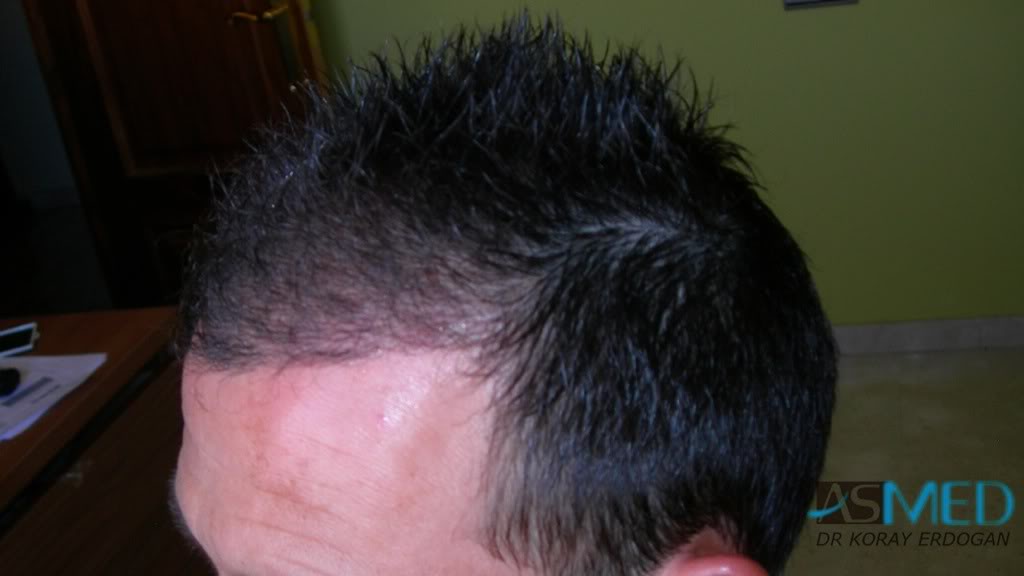 Norwood3 2400-grafts-FUE-4 104e358f