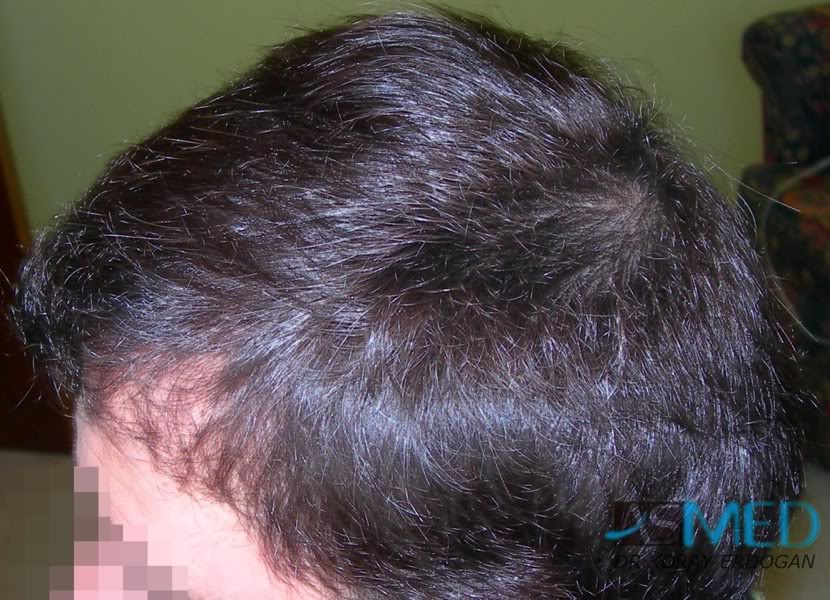 Norwood3 2400-grafts-FUE-4 18f85c9a