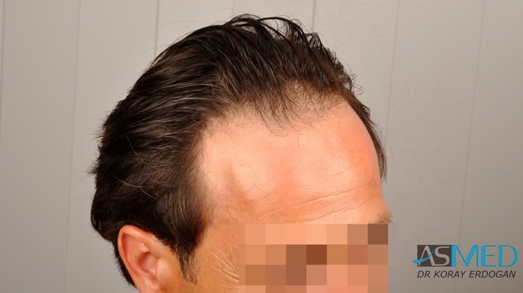 Norwood3 2400-grafts-FUE-4 1a82225d