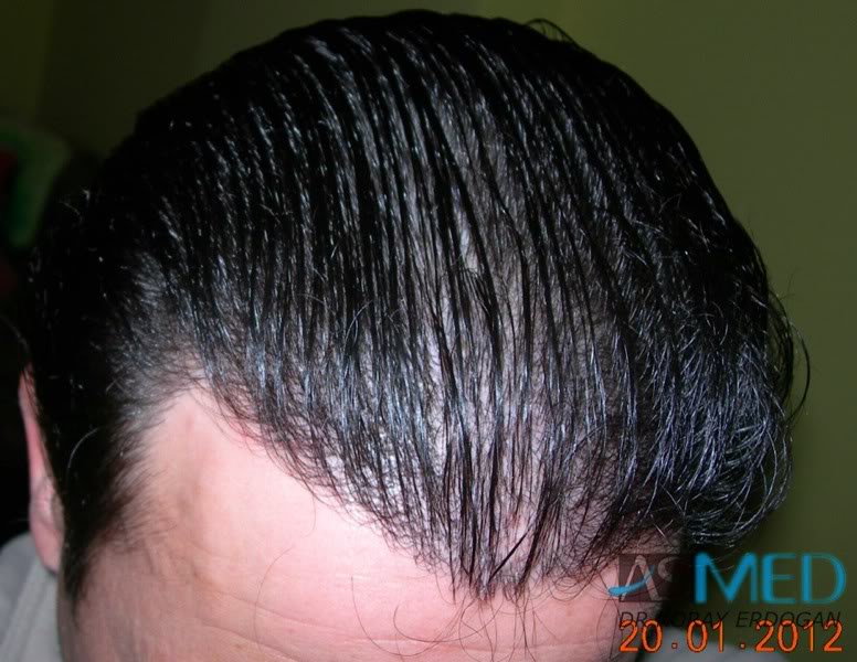 Norwood3 2400-grafts-FUE-4 3a2bea99