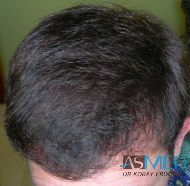 Norwood3 2400-grafts-FUE-4 3ea155ca