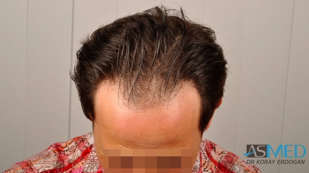 Norwood3 2400-grafts-FUE-4 60caea5b