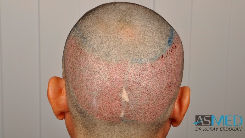 Norwood3 2400-grafts-FUE-4 689877b0