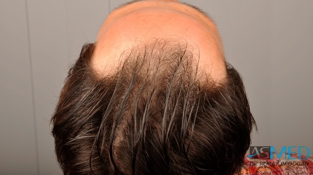 Norwood3 2400-grafts-FUE-4 727875ab