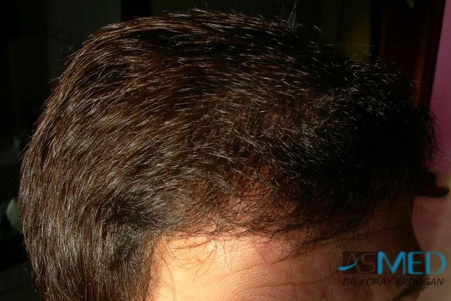 Norwood3 2400-grafts-FUE-4 7f56a40b