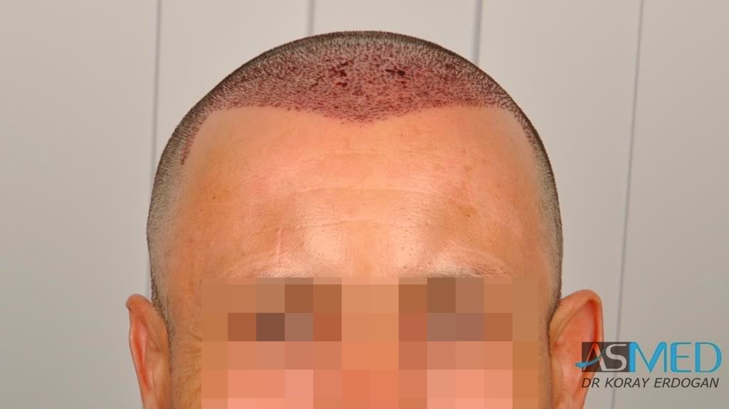 Norwood3 2400-grafts-FUE-4 9b2fa8a3