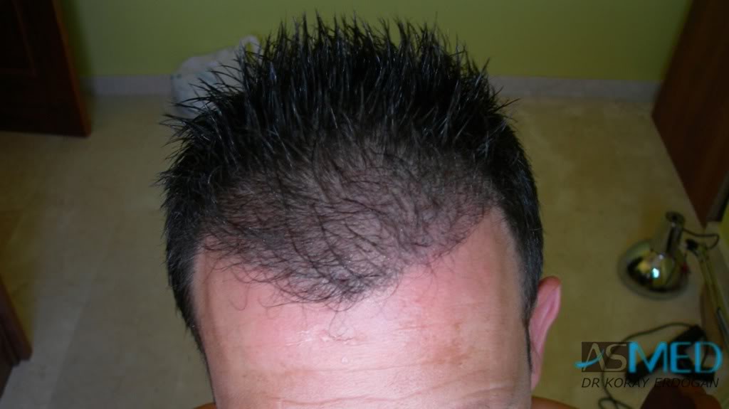 Norwood3 2400-grafts-FUE-4 a6cae9e4