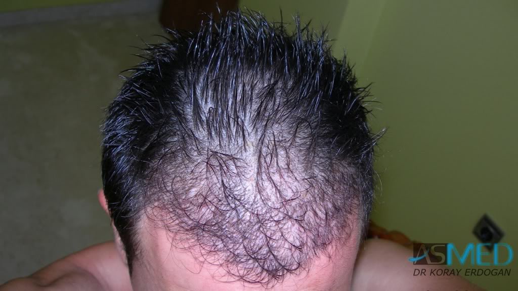 Norwood3 2400-grafts-FUE-4 c5aeb36a