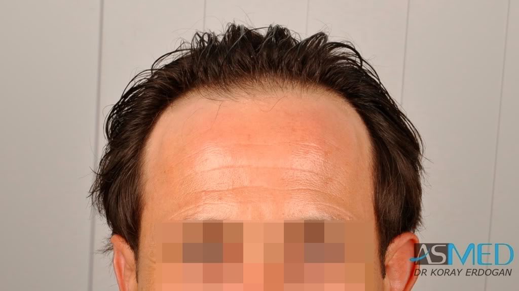 Norwood3 2400-grafts-FUE-4 d1c08193