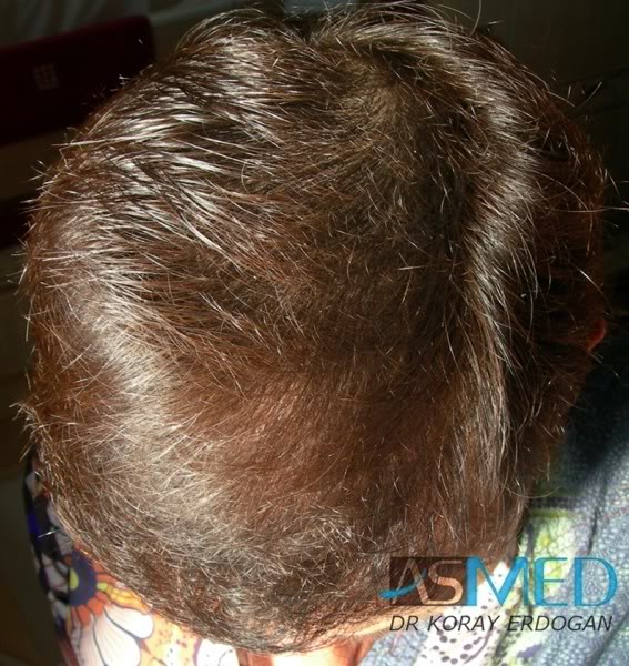 Norwood3 2400-grafts-FUE-4 d4f79e33