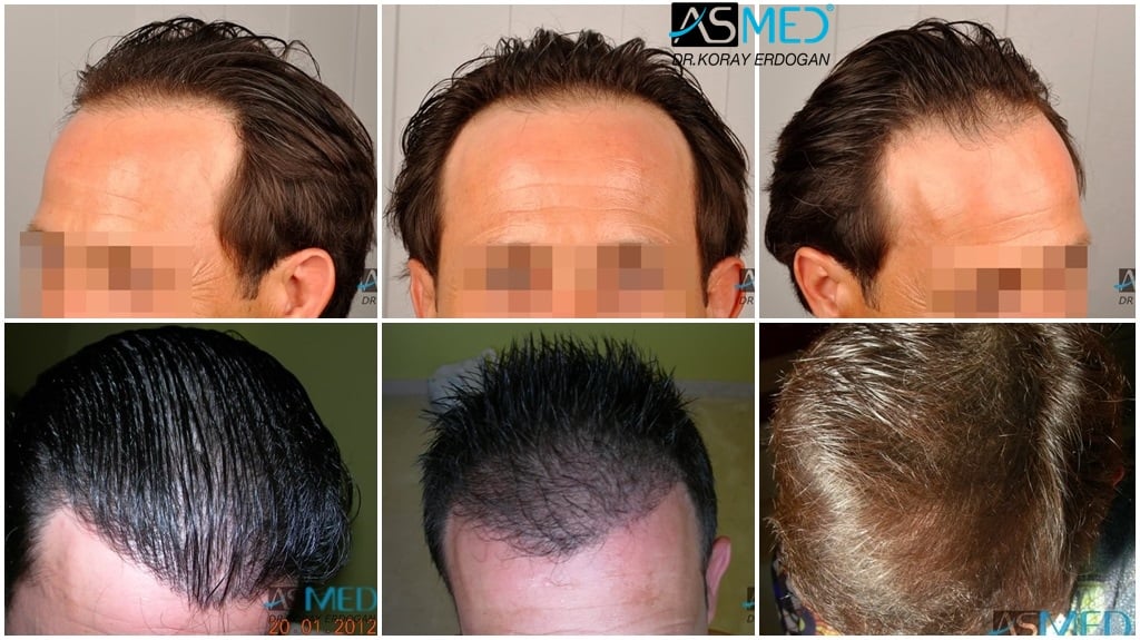 2400-grafts-FUE-4 gallery