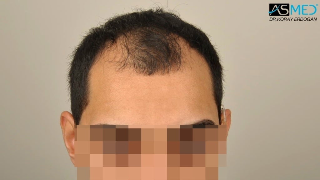 2400-grafts-FUE gallery