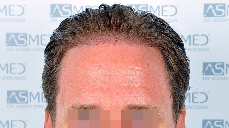 Norwood3 2450-grafts-FUE before Before%201_V2