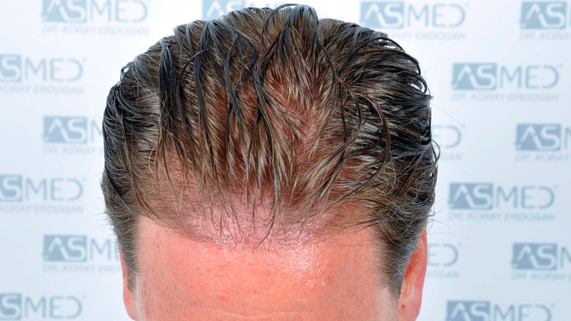 Norwood3 2450-grafts-FUE before Before%202_V2