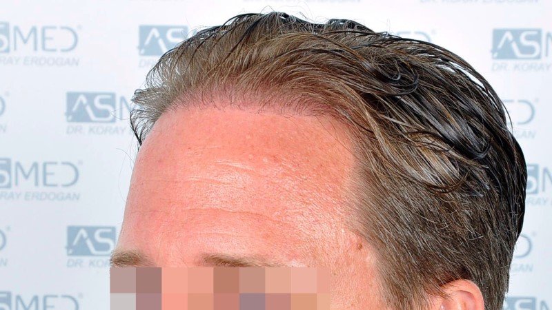 Norwood3 2450-grafts-FUE before Before%203_V2